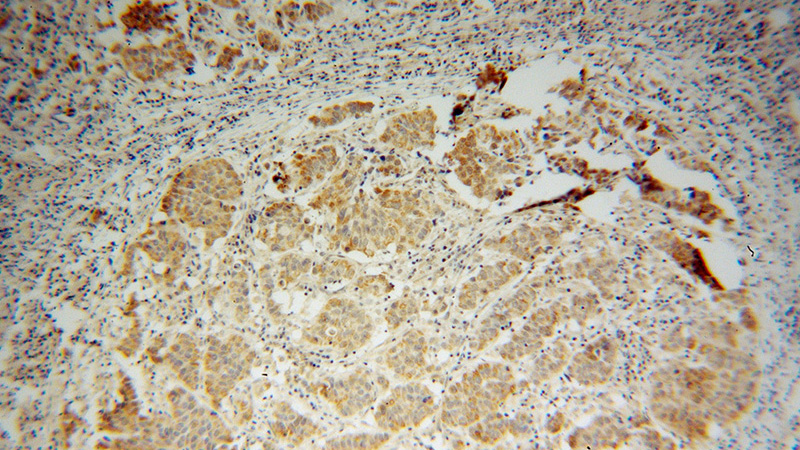 Immunohistochemical of paraffin-embedded human prostate cancer using Catalog No:115536(SPAG8 antibody) at dilution of 1:100 (under 10x lens)