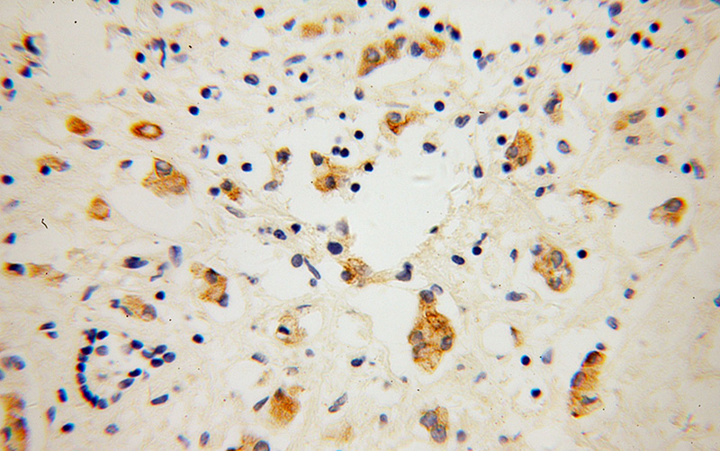 Immunohistochemical of paraffin-embedded human breast cancer using Catalog No:116535(UBE2S antibody) at dilution of 1:50 (under 40x lens)