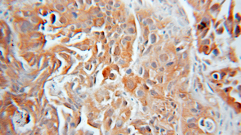 Immunohistochemical of paraffin-embedded human prostate cancer using Catalog No:111568(HSP70 antibody) at dilution of 1:100 (under 10x lens)