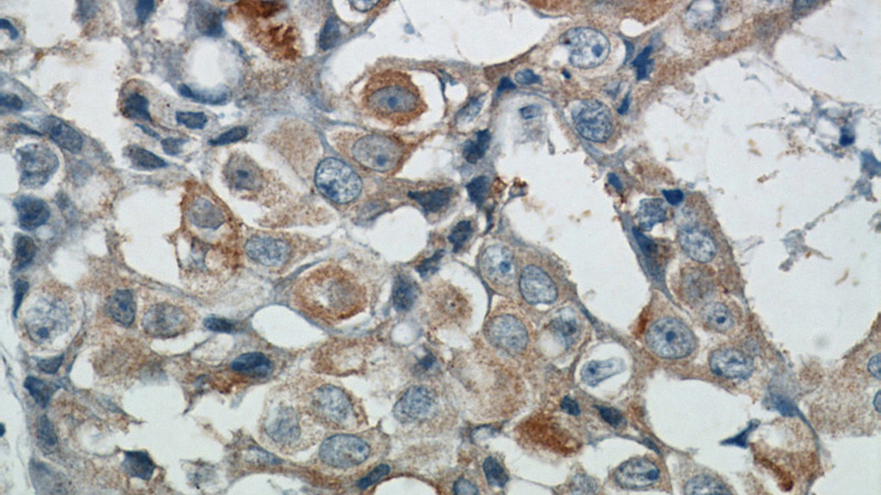 Immunohistochemical of paraffin-embedded human breast cancer using Catalog No:107690(ACP5 antibody) at dilution of 1:25 (under 40x lens)