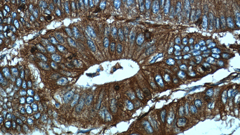 Immunohistochemistry of paraffin-embedded human colon cancer tissue slide using Catalog No:113503(PALLD,palladin Antibody) at dilution of 1:50 (under 40x lens)