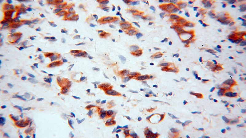 Immunohistochemical of paraffin-embedded human gliomas using Catalog No:113729(PEX19 antibody) at dilution of 1:100 (under 40x lens)