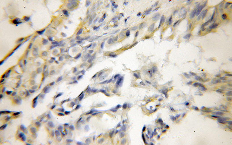 Immunohistochemical of paraffin-embedded human lung cancer using Catalog No:110680(FKBP7 antibody) at dilution of 1:50 (under 10x lens)