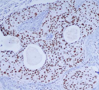 Immunohistochemical analysis of paraffin-embedded Breast cancer using DNA-PKcs mouse mAb (1/200 dilution).Antigen retrieval was performed by pressure cooking in citrate buffer (pH 6.0).