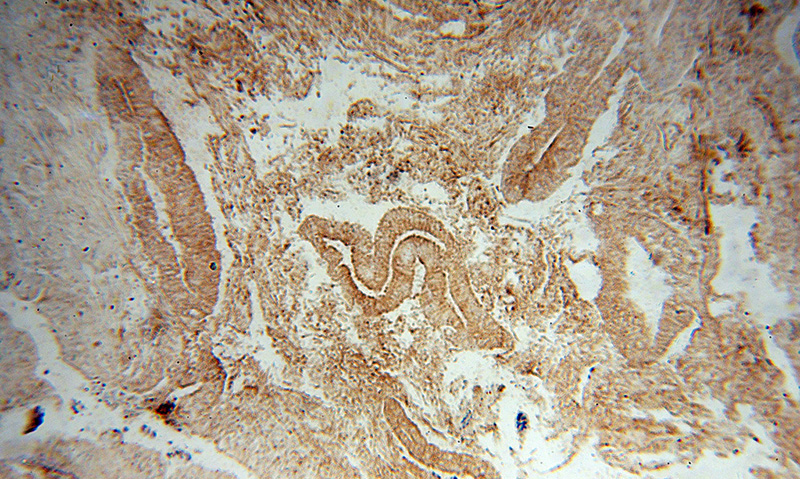 Immunohistochemical of paraffin-embedded human colon cancer using Catalog No:107881(ALPL antibody) at dilution of 1:100 (under 10x lens)