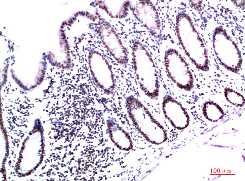 Immunohistochemical analysis of paraffin-embedded Human Colon Carcinoma Tissue using HP-1γ  Mouse mAb diluted at 1:200.