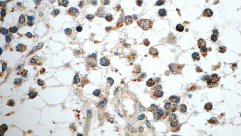 Immunohistochemistry of paraffin-embedded human gliomas tissue slide using Catalog No:111770(IL1F6 Antibody) at dilution of 1:50 (under 40x lens)