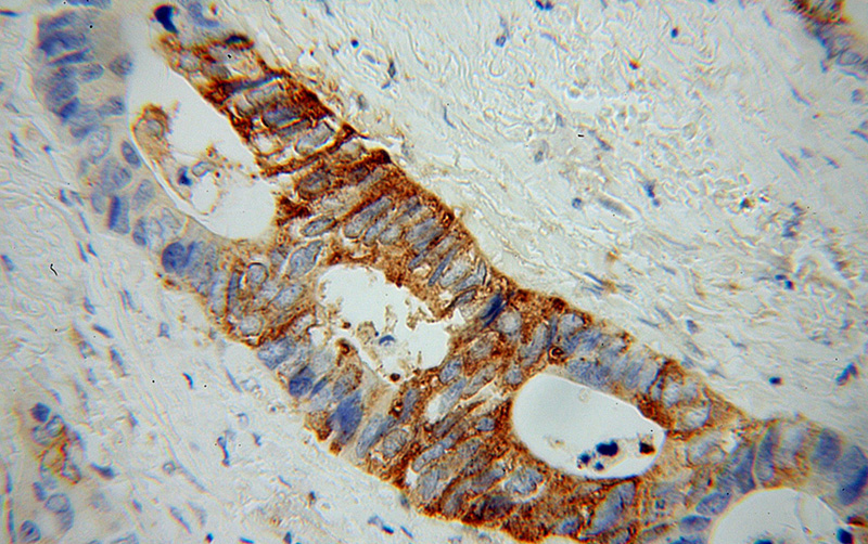 Immunohistochemical of paraffin-embedded human colon cancer using Catalog No:115845(TLN1 antibody) at dilution of 1:100 (under 40x lens)