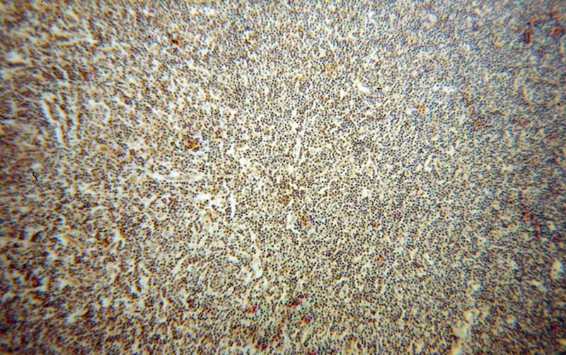 Immunohistochemical of paraffin-embedded human lymphoma using Catalog No:111622(IFITM1 antibody) at dilution of 1:50 (under 10x lens)