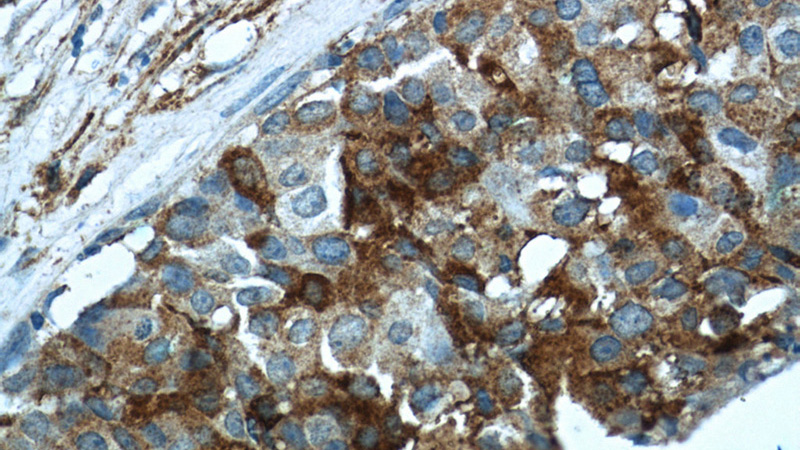 Immunohistochemistry of paraffin-embedded human breast cancer tissue slide using Catalog No:113610(PXN Antibody) at dilution of 1:50 (under 40x lens)