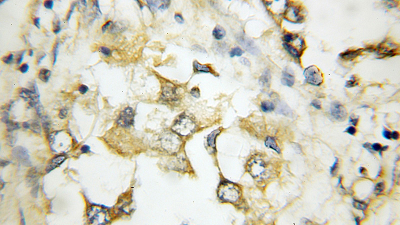 Immunohistochemical of paraffin-embedded human breast cancer using Catalog No:109635(CXADR antibody) at dilution of 1:50 (under 10x lens)