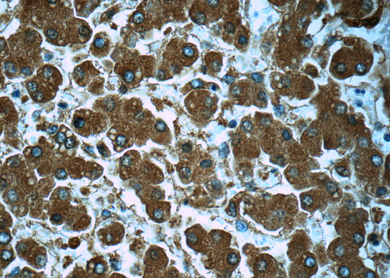 Immunohistochemistry of paraffin-embedded human liver tissue slide using Catalog No:107861(SERPINA3,AACT Antibody) at dilution of 1:50
