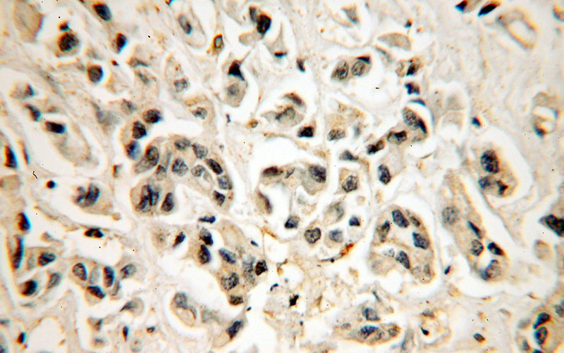 Immunohistochemical of paraffin-embedded human breast cancer using Catalog No:108388(BCL10 antibody) at dilution of 1:100 (under 40x lens)