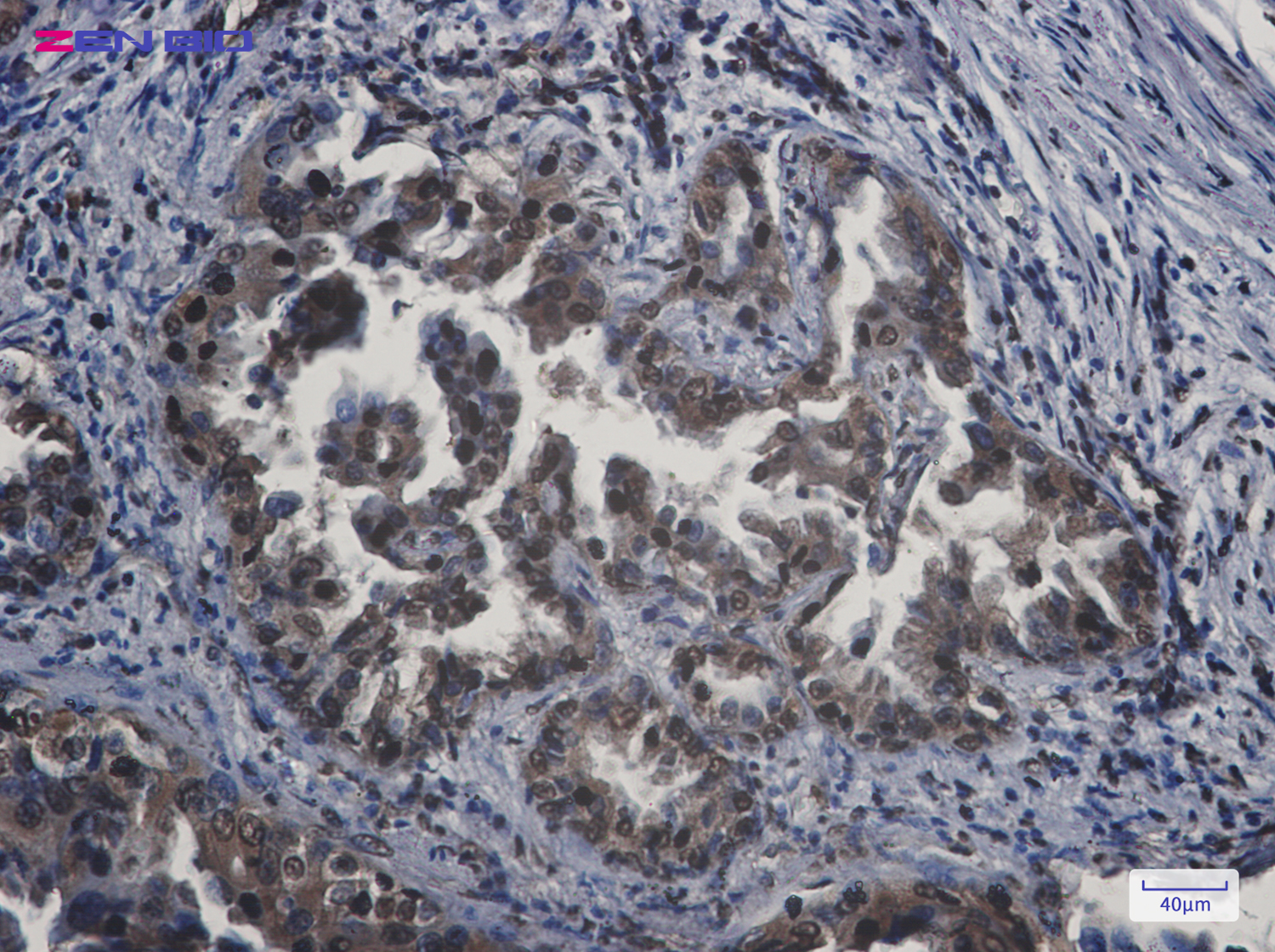 Immunohistochemistry of APPL in paraffin-embedded Human lung cancer tissue using APPL Rabbit pAb at dilution 1/20