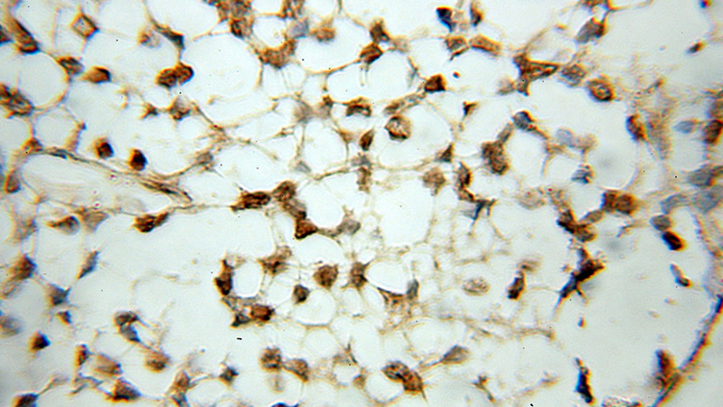 Immunohistochemical of paraffin-embedded human gliomas using Catalog No:114054(POLR3K antibody) at dilution of 1:100 (under 10x lens)
