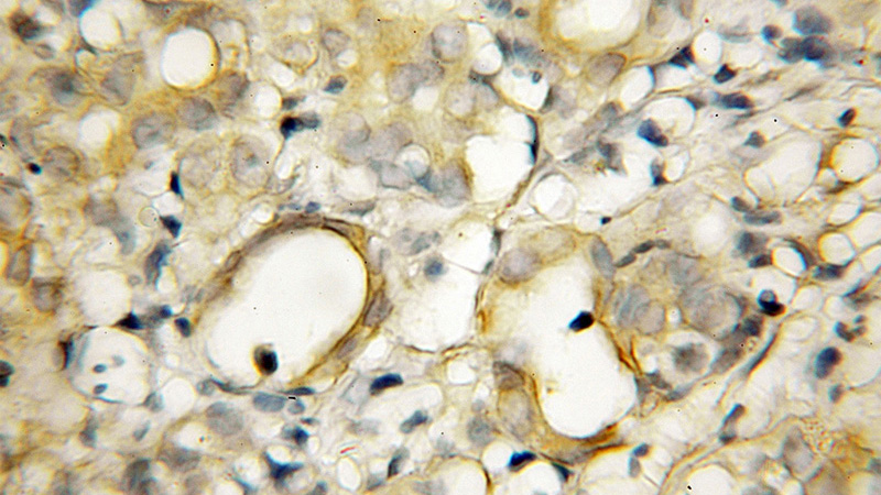 Immunohistochemical of paraffin-embedded human pancreas cancer using Catalog No:111046(GOPC antibody) at dilution of 1:50 (under 10x lens)