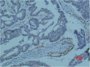 Immunohistochemical analysis of paraffin-embedded human colon caricnoma using Survivin Monoclonal Antibody.