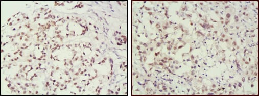 Immunohistochemical analysis of paraffin-embedded human breast cancer (left) and lung cancer (right) tissues using MSH2 mouse mAb with DAB staining, showing nuclear localization.