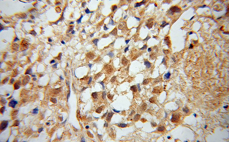 Immunohistochemical of paraffin-embedded human osteosarcoma using Catalog No:112781(MTM1 antibody) at dilution of 1:100 (under 40x lens)