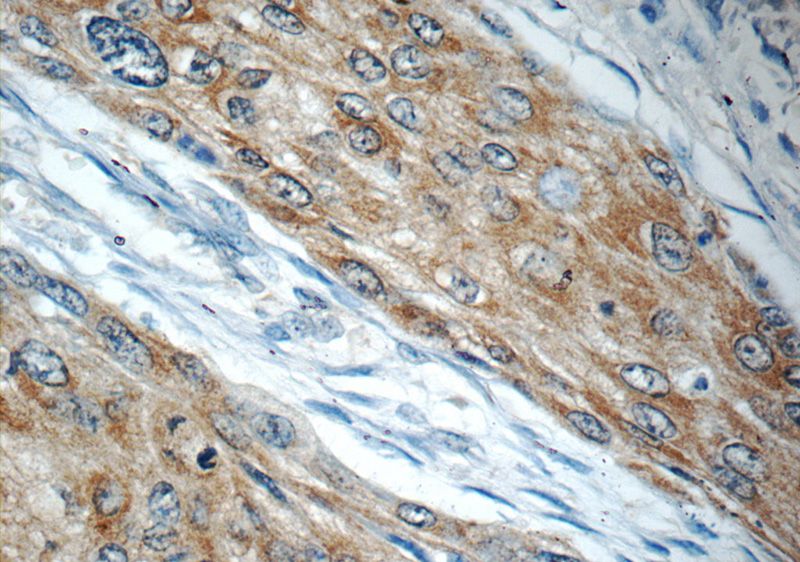 Immunohistochemistry of paraffin-embedded human oesophagus cancer tissue slide using Catalog No:112408(LYNX1 Antibody) at dilution of 1:50 (under 40x lens)