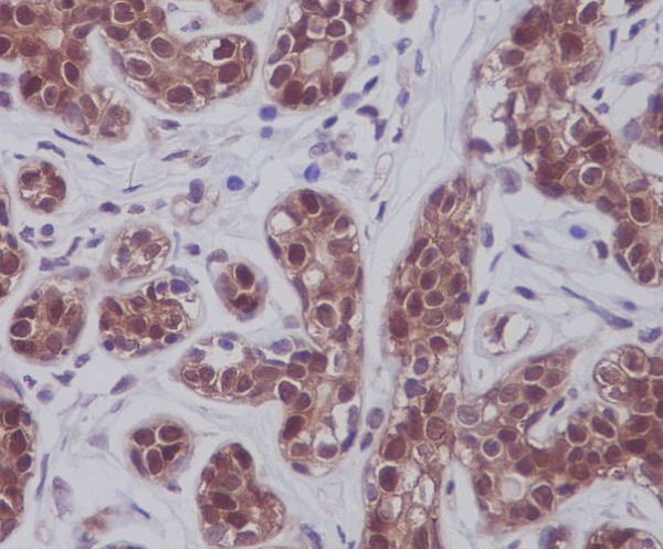 Immunohistochemical analysis of paraffin-embedded human breast, using STAT5A/B Antibody.