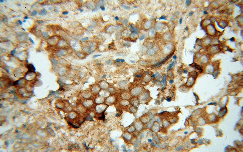 Immunohistochemical of paraffin-embedded human prostate cancer using Catalog No:107709(ACTL7B antibody) at dilution of 1:100 (under 40x lens)