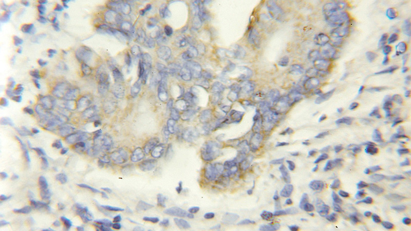 Immunohistochemical of paraffin-embedded human colon cancer using Catalog No:113797(ACCS antibody) at dilution of 1:50 (under 40x lens)
