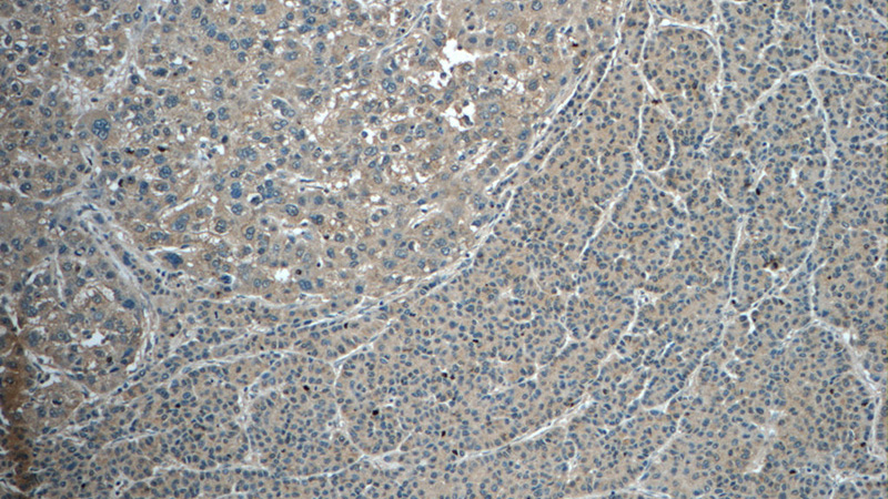 Immunohistochemistry of paraffin-embedded human liver cancer tissue slide using Catalog No:109637(CXCL12 Antibody) at dilution of 1:50 (under 10x lens)