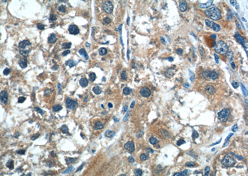 Immunohistochemistry of paraffin-embedded human liver cancer tissue slide using Catalog No:109203(CGNL1 Antibody) at dilution of 1:50 (under 40x lens)