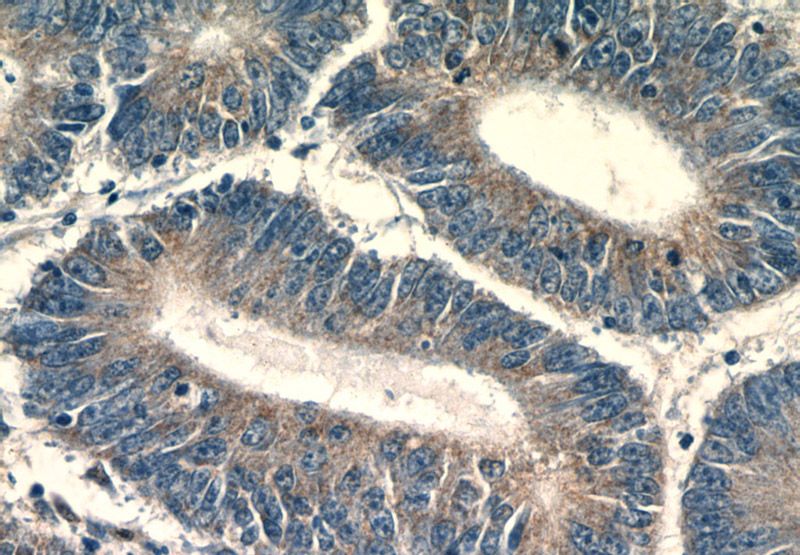 Immunohistochemistry of paraffin-embedded human colon cancer tissue slide using Catalog No:111510(HNRNPL Antibody) at dilution of 1:50 (under 40x lens)