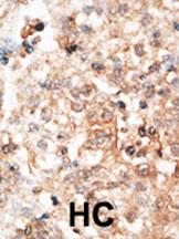 Formalin-fixed and paraffin-embedded human cancer tissue reacted with the primary antibody, which was peroxidase-conjugated to the secondary antibody, followed by DAB staining. This data demonstrates the use of this antibody for immunohistochemistry; clin