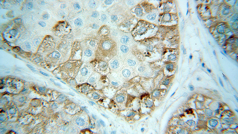 Immunohistochemical of paraffin-embedded human liver cancer using Catalog No:109701(CYP3A5 antibody) at dilution of 1:100 (under 40x lens)