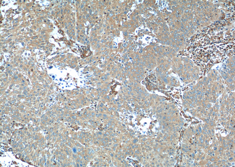 Immunohistochemistry of paraffin-embedded human lung cancer tissue slide using Catalog No:114922(RRBP1 Antibody) at dilution of 1:50 (under 10x lens)