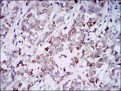 Immunohistochemical analysis of paraffin-embedded bladder cancer tissues using GAB1 mouse mAb with DAB staining.