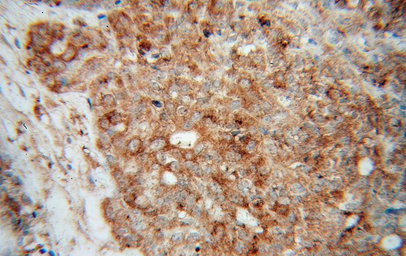 Immunohistochemical of paraffin-embedded human breast cancer using Catalog No:108839(CAPRIN1 antibody) at dilution of 1:100 (under 40x lens)