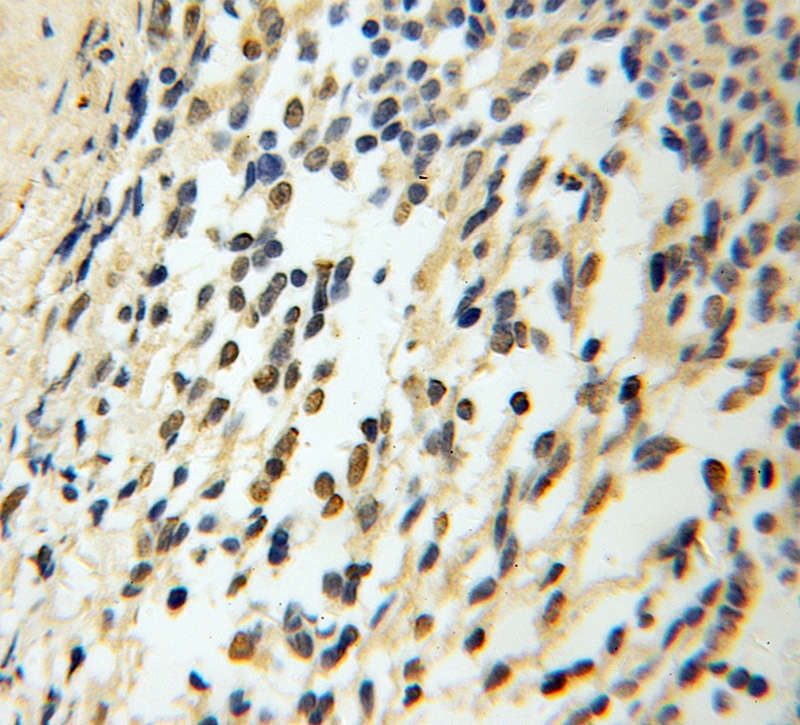 Immunohistochemical of paraffin-embedded human medulloblastoma using Catalog No:109303(CHTF18 antibody) at dilution of 1:100 (under 10x lens)