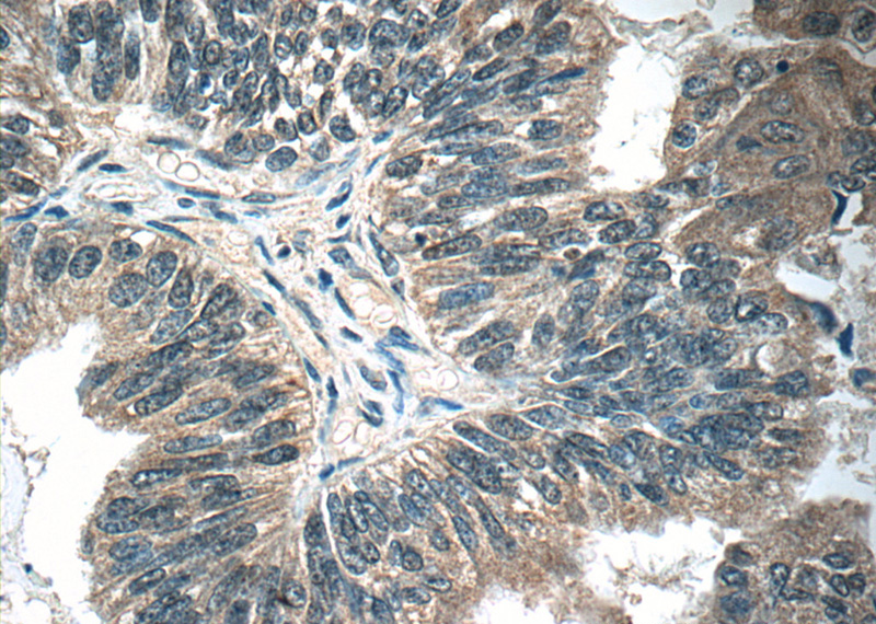 Immunohistochemistry of paraffin-embedded human ovary tumor tissue slide using Catalog No:113517(OTUD6B Antibody) at dilution of 1:50 (under 40x lens)