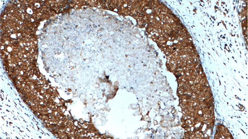 Immunohistochemistry of paraffin-embedded human breast cancer tissue slide using Catalog No:107077(BAX Antibody) at dilution of 1:200 (under 10x lens). heat mediated antigen retrieved with Tris-EDTA buffer(pH9).