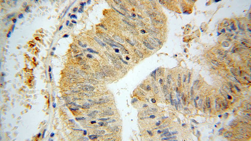 Immunohistochemical of paraffin-embedded human liver cancer using Catalog No:114734(RND3 antibody) at dilution of 1:50 (under 40x lens)