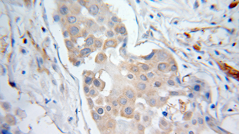 Immunohistochemical of paraffin-embedded human pancreas cancer using Catalog No:115680(STARD5 antibody) at dilution of 1:10 (under 10x lens)