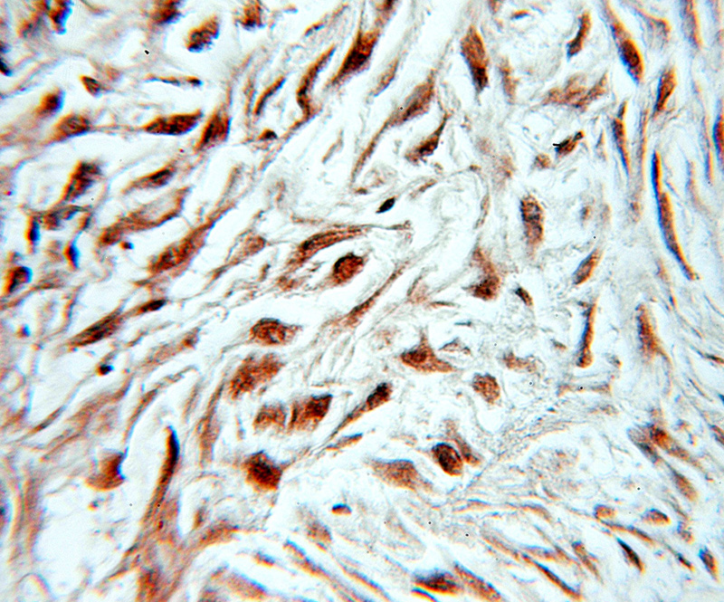 Immunohistochemical of paraffin-embedded human ovary tumor using Catalog No:112870(Musashi-2 antibody) at dilution of 1:10 (under 10x lens)