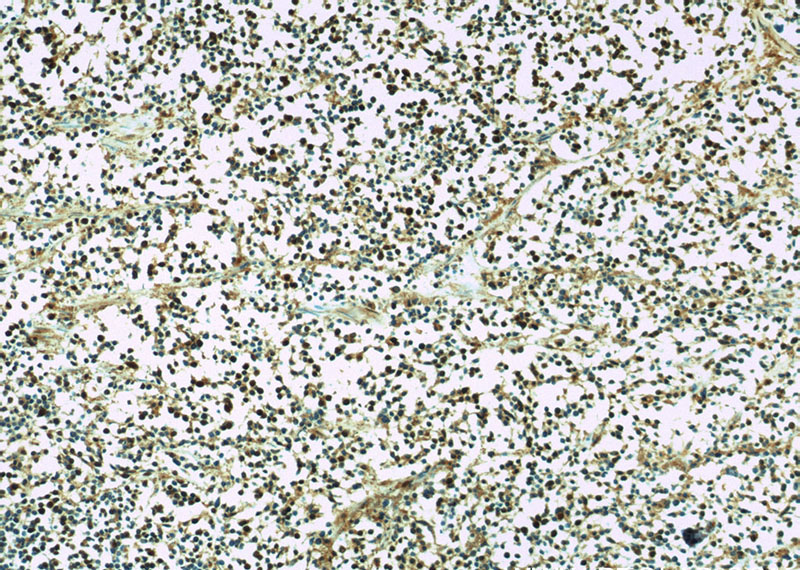 Immunohistochemistry of paraffin-embedded human lung cancer slide using Catalog No:114400(PSMD4 Antibody) at dilution of 1:50