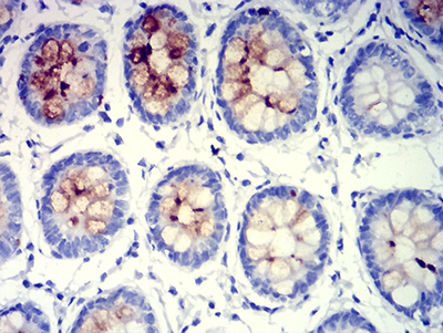 Fig3: Immunohistochemical analysis of paraffin-embedded rectum tissues using anti-MUC5B antibody. The section was pre-treated using heat mediated antigen retrieval with Tris-EDTA buffer (pH 8.0) for 20 minutes. The tissues were blocked in 5% BSA for 30 minutes at room temperature, washed with ddH2O and PBS, and then probed with the primary antibody ( 1/100) for 30 minutes at room temperature. The detection was performed using an HRP conjugated compact polymer system. DAB was used as the chromogen. Tissues were counterstained with hematoxylin and mounted with DPX.