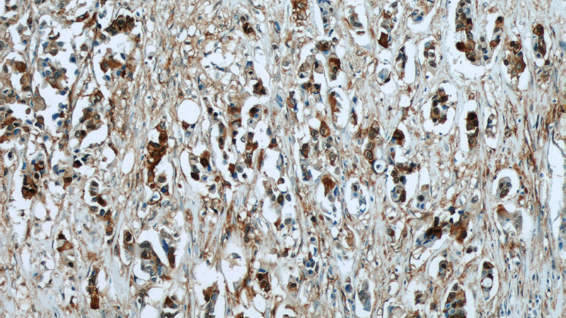 Immunohistochemical of paraffin-embedded human breast cancer using Catalog No:107056(ANXA2 antibody) at dilution of 1:50 (under 10x lens)