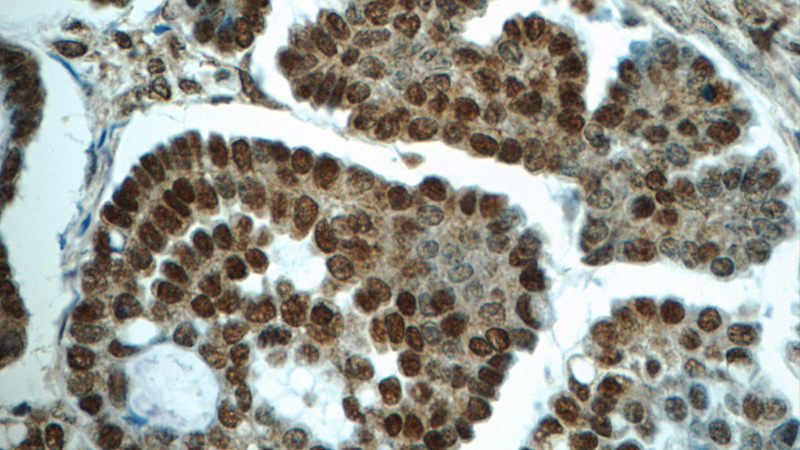 Immunohistochemistry of paraffin-embedded human ovary tumor tissue slide using Catalog No:115570(SPIN1 Antibody) at dilution of 1:50 (under 40x lens)