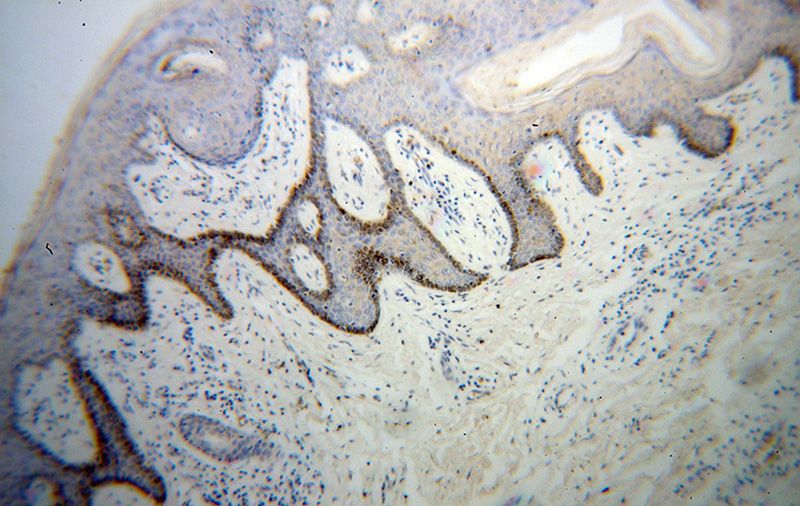 Immunohistochemical of paraffin-embedded human skin cancer using Catalog No:109592(UNR; CSDE1 antibody) at dilution of 1:50 (under 10x lens)