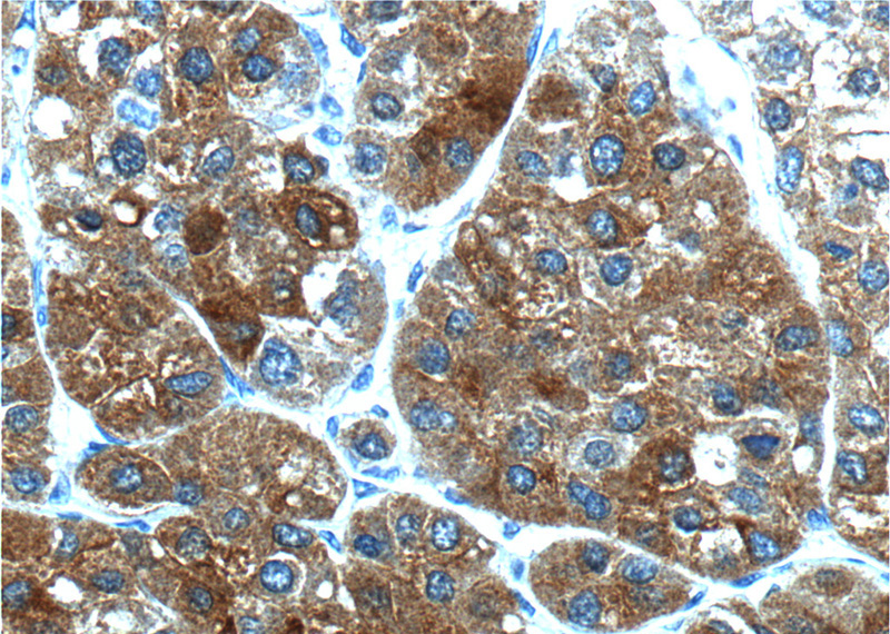 Immunohistochemistry of paraffin-embedded human liver cancer tissue slide using Catalog No:113725(PEX1 Antibody) at dilution of 1:200 (under 40x lens).