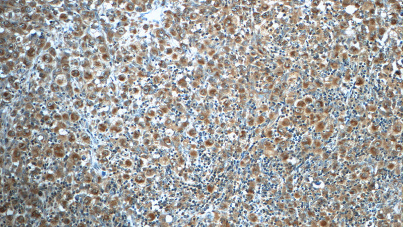 Immunohistochemistry of paraffin-embedded human lymphoma slide using Catalog No:114753(RNF213 Antibody) at dilution of 1:50