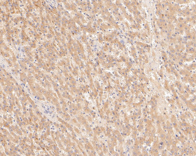 Fig2:; Immunohistochemical analysis of paraffin-embedded human liver tissue using anti-TREM2 antibody. The section was pre-treated using heat mediated antigen retrieval with Tris-EDTA buffer (pH 8.0-8.4) for 20 minutes.The tissues were blocked in 5% BSA for 30 minutes at room temperature, washed with ddH; 2; O and PBS, and then probed with the primary antibody ( 1/200) for 30 minutes at room temperature. The detection was performed using an HRP conjugated compact polymer system. DAB was used as the chromogen. Tissues were counterstained with hematoxylin and mounted with DPX.