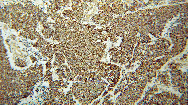 Immunohistochemical of paraffin-embedded human lung cancer using Catalog No:112295(LONP1 antibody) at dilution of 1:50 (under 10x lens)